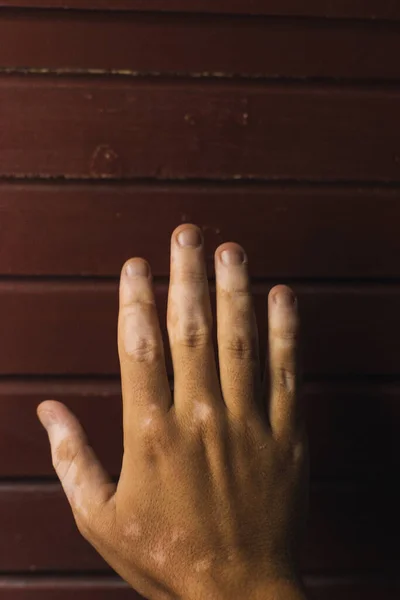 Tahta bir zeminde vitiligo ile el.