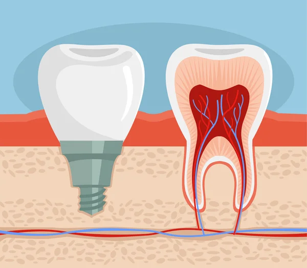 Implante dental. Ilustración plana del vector — Archivo Imágenes Vectoriales