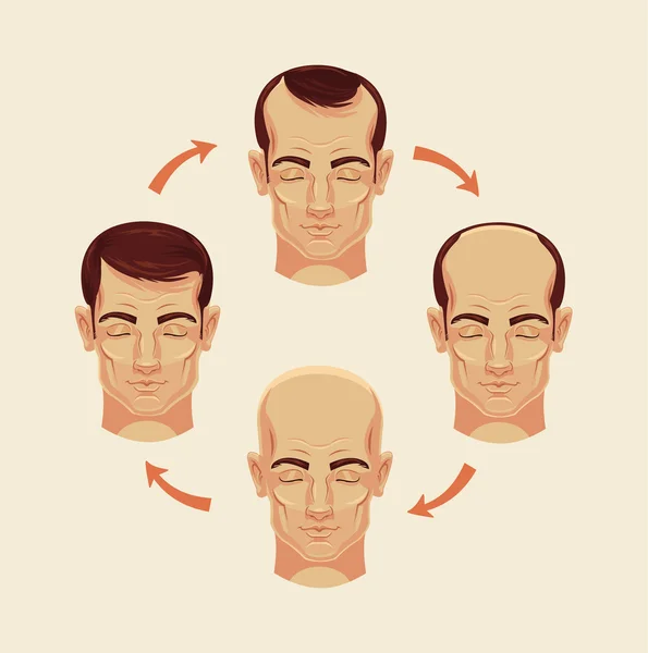 Stages of baldness. Vector flat cartoon illustration — Stock Vector