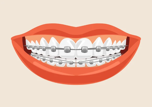 Женщина улыбается с брекетами. Векторная плоская иллюстрация — стоковый вектор