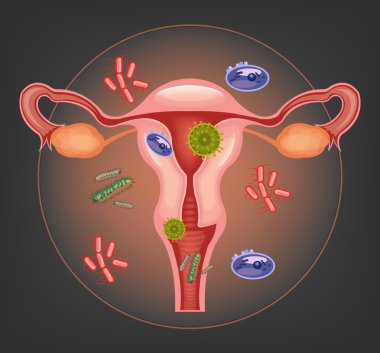 Ill female reproductive system. Vector illustration clipart