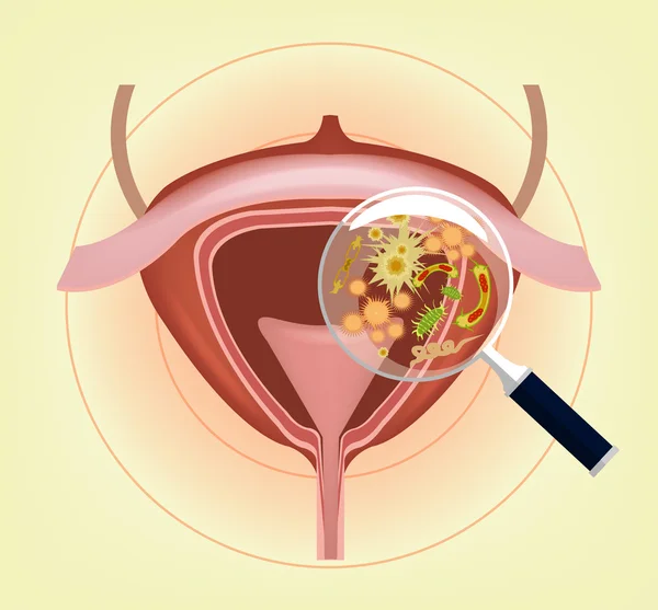 Menselijke blaas met bacteriën, ziektekiemen en vergrootglas. Vectorillustratie — Stockvector