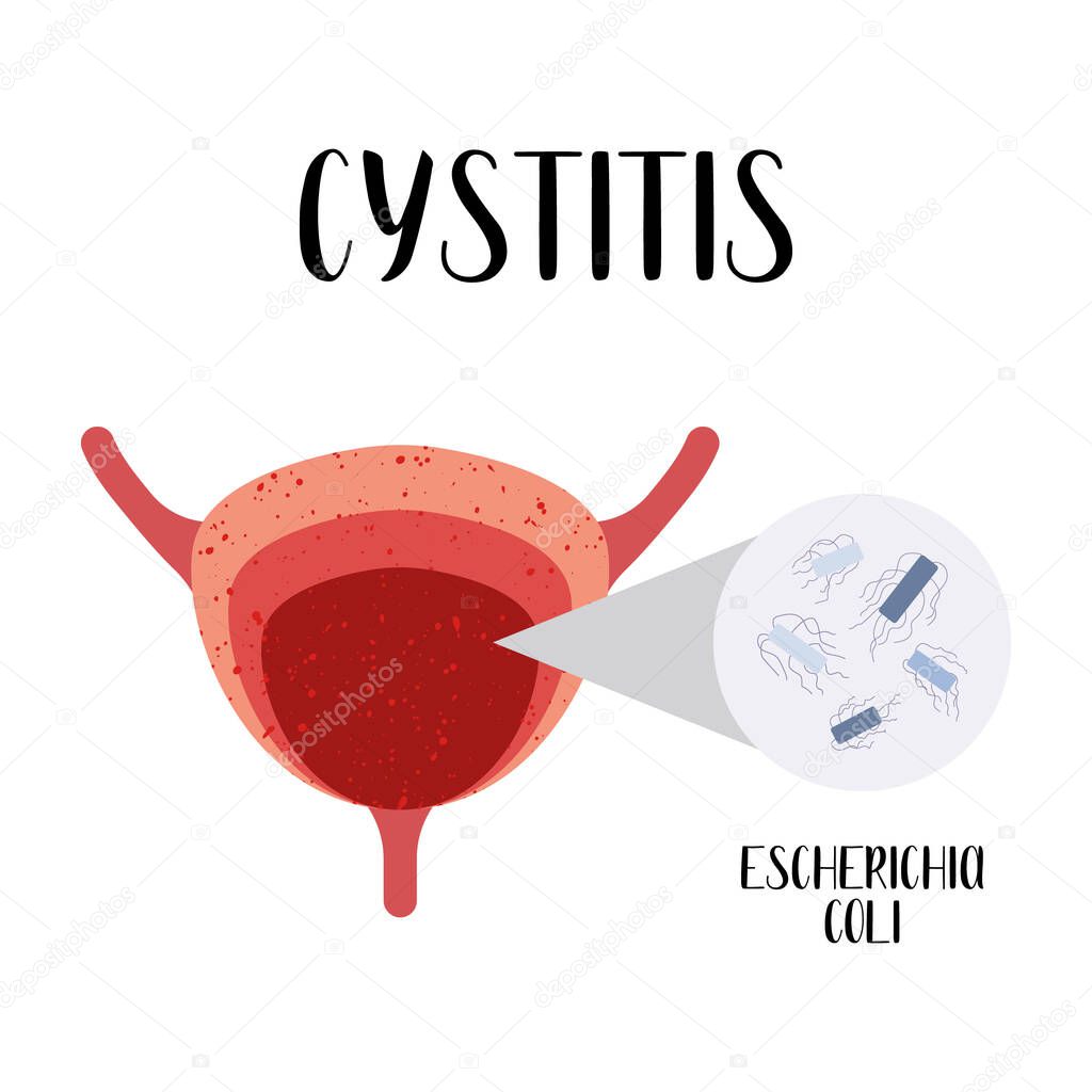 Cystitis. Escherichia coli. Bladder disease. Urology. Vector flat illustration. Perfect for flyer, medical brochure, banner, landing page, website
