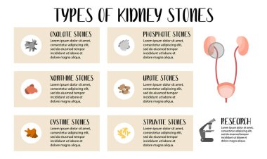 Types of kidneys stones. Oxalate, phosphate, xanthine, urate, cystine, struvite stones. Urolithiasis disease. Kidney and bladder disease. Vector flat illustration. Perfect for flyer, medical brochure clipart