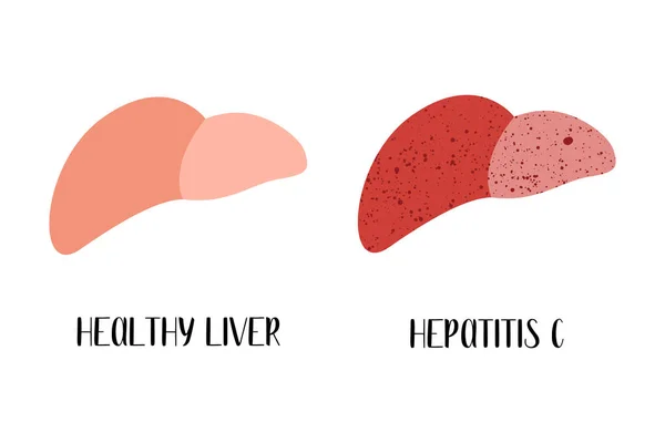 Hígado Sano Enfermo Hepatitis Enfermedad Hepática Hepatología Daño Hepático Ilustración — Vector de stock