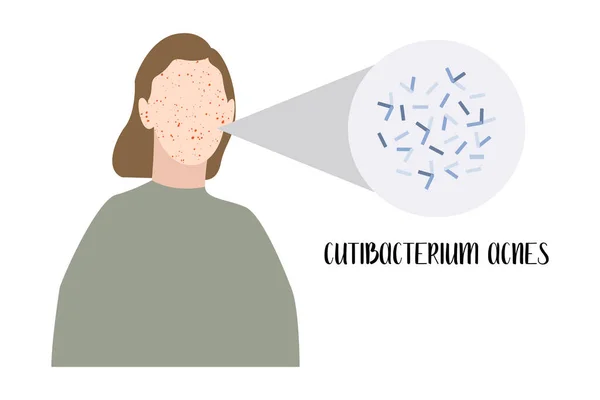 Cutibacterium Acnes Propionibacterium Gram Positif Bakteri Jerawat Penyakit Kulit Inflamasi - Stok Vektor