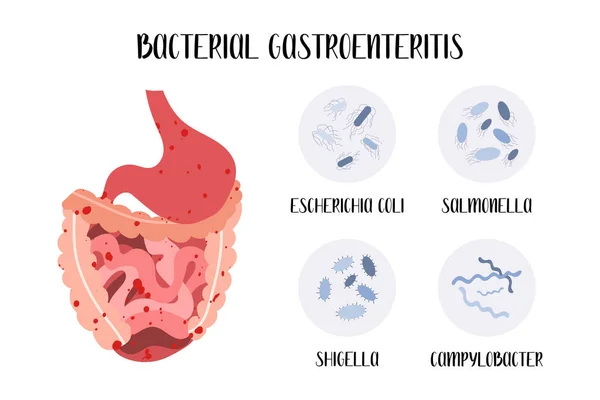 Bacterial Gastroenteritis Stomach Gastric Gut Intestine Inflammatory Disease Pathogen Escherichia — Stock Vector