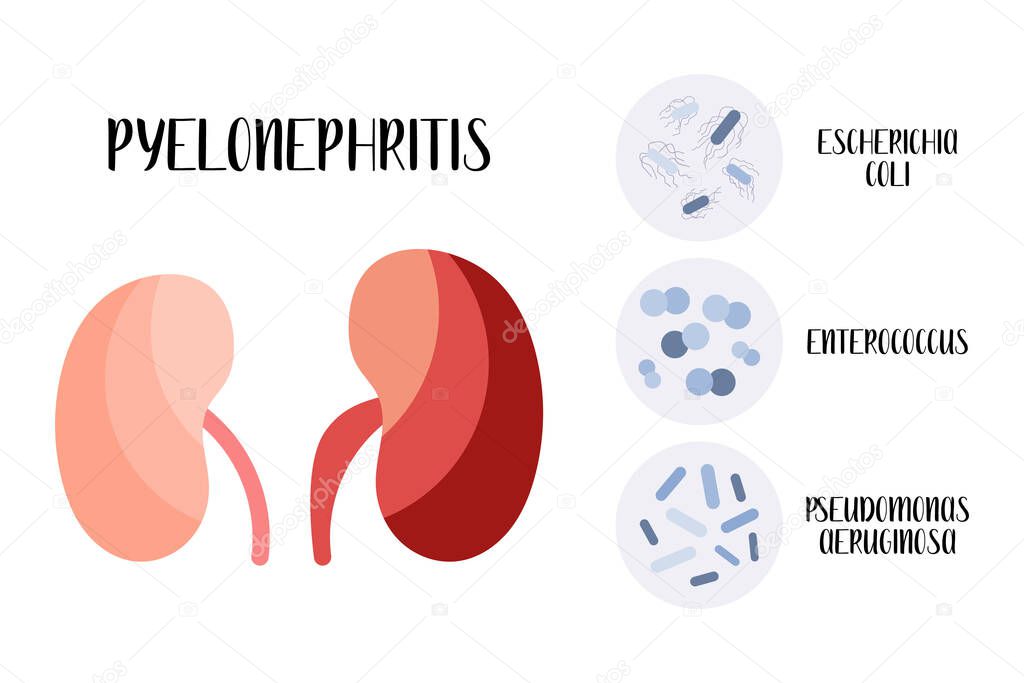 Pyelonephritis. Kidney, urinary system inflammatory disease. Pathogen: Escherichia coli, Enterococcus, Pseudomonas aeruginosa. Urology. Vector flat cartoon illustration