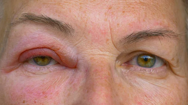 CLOSE UP: Caucasian lady with an infected and swollen eye looks into the camera. — Stock Photo, Image