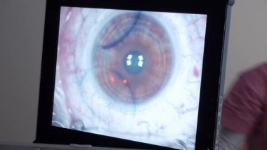 lazer göz cerrahisi