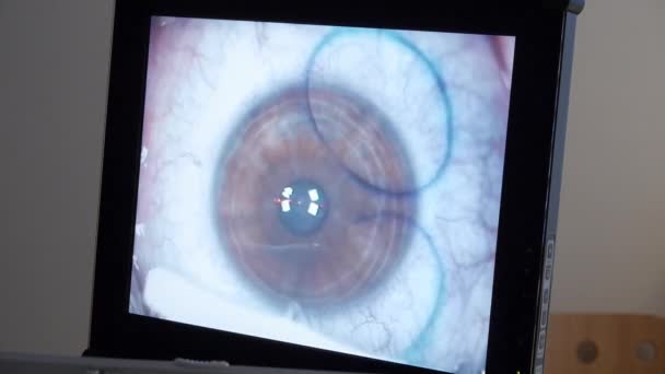 Chirurgie des yeux laser — Video