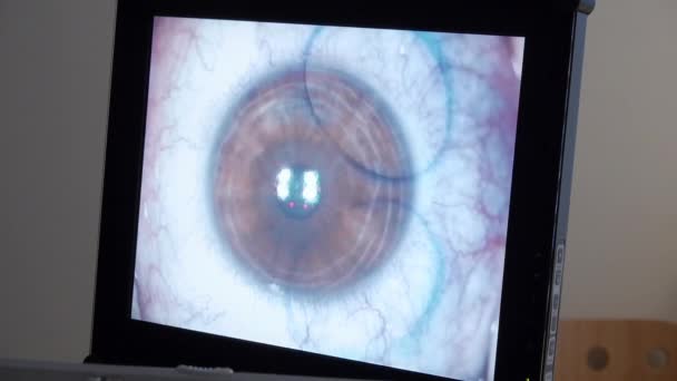 Laser oogchirurgie — Stockvideo