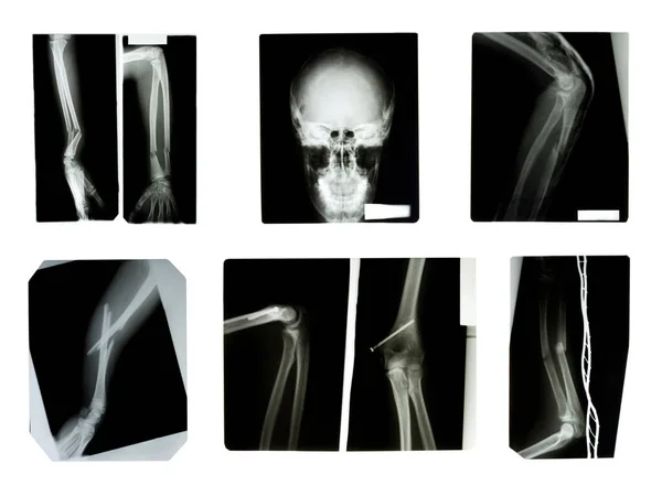 사람의 엑스레이 사진을 클로즈업 — 스톡 사진
