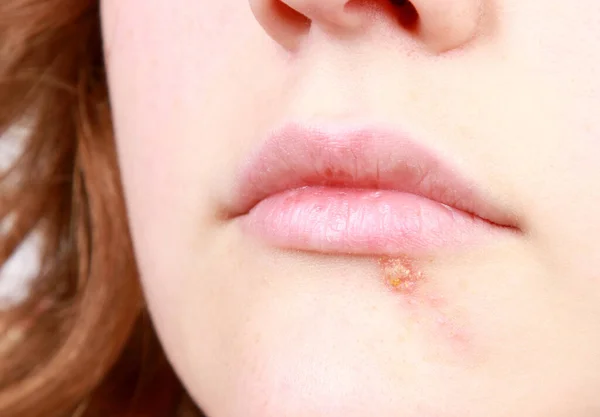 Closeup Shot Common Cold Sore Virus Herpes Woman Face — Fotografia de Stock