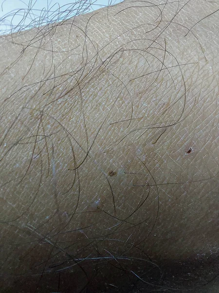 Macro Shot Hairy Dry Skin Man — Stock Photo, Image
