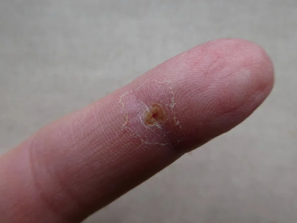 Selective Focus Shot Finger Wound Scalding Skin — Stock Photo, Image