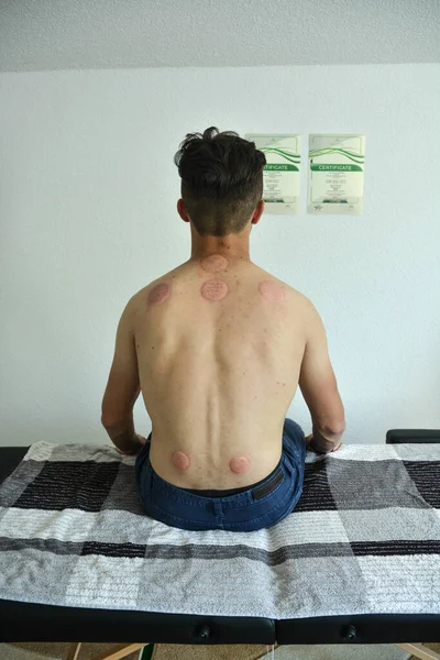 Die Rückenansicht Eines Jungen Mannes Nach Einer Hijama Behandlung — Stockfoto