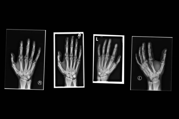 Illustration Radiographie Des Mains Gauche Droite Sur Fond Noir Photo De Stock