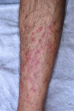 A vertical closeup of post-vaccination rashes on the skin clipart