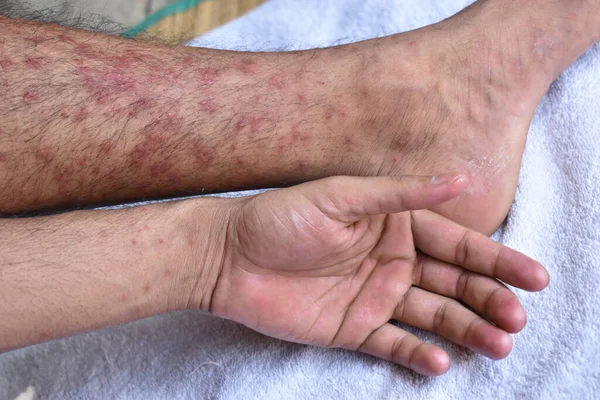 A closeup of post-vaccination rashes on the skin