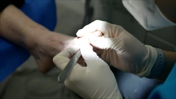 Closeup Shot Deep Toenail Cleaning Process Professional Doctor Hospital — Αρχείο Βίντεο