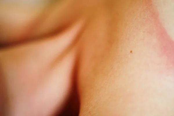 Closeup Shot Details Sunburnt Human Skin — Stock Photo, Image