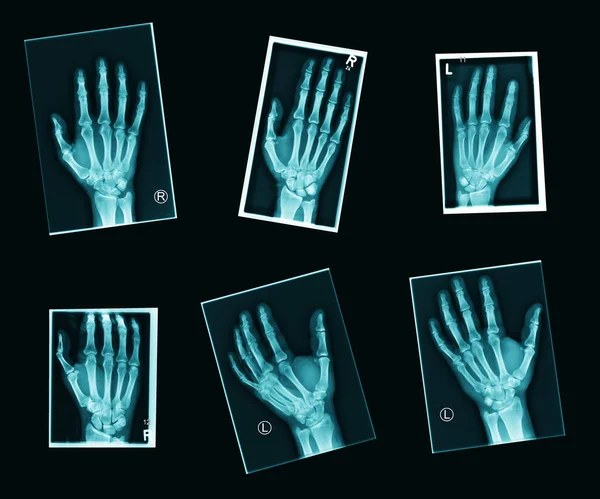 六种不同的人类手部X光照片 — 图库照片