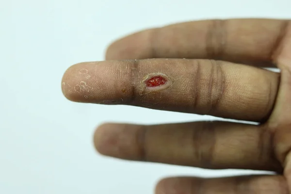 배경에 고립된 사람의 손가락에 사마귀를 부상을 사람의 클로즈업 — 스톡 사진