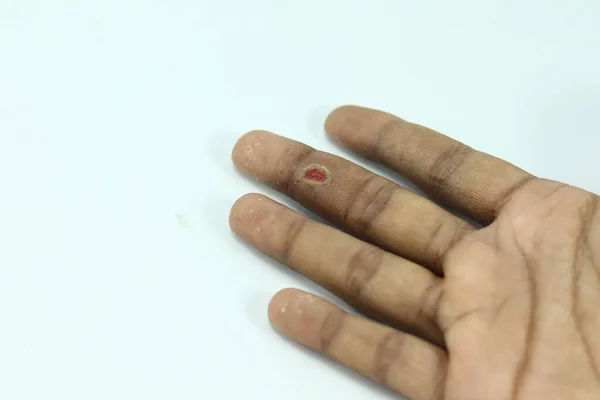 Primer Plano Una Herida Después Extraer Una Verruga Dedo Hombre — Foto de Stock