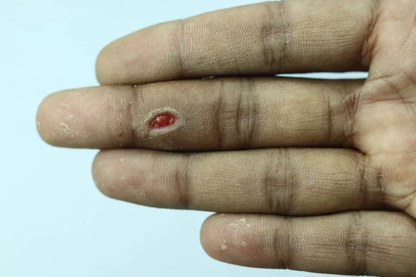 Tiro Close Uma Ferida Depois Remover Uma Verruga Dedo Homem — Fotografia de Stock