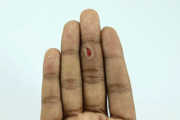 Primer Plano Una Herida Después Extraer Una Verruga Dedo Hombre —  Fotos de Stock