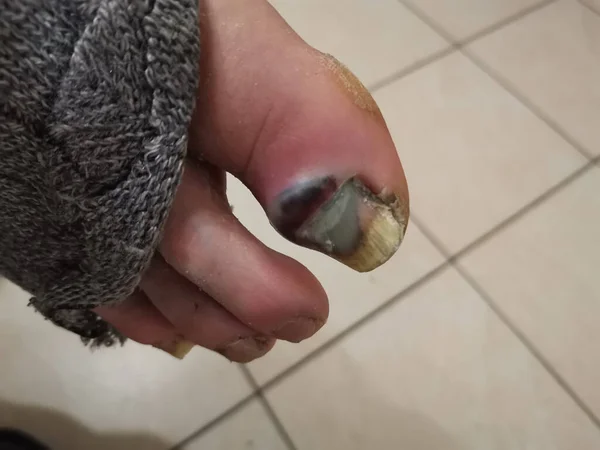 Primer Plano Las Uñas Los Pies Heridas Enfermas — Foto de Stock