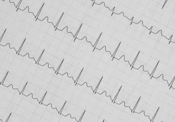 Eine Nahaufnahme Des Ekg Kardiogramms Eines Patienten Auf Papier — Stockfoto