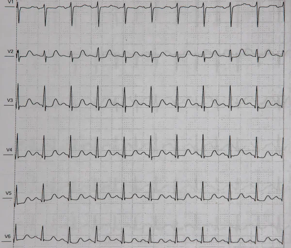 Zbliżenie Ekg Rytmem Serca — Zdjęcie stockowe