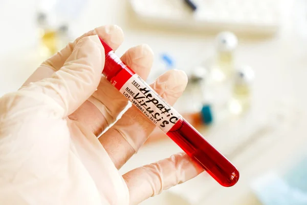 Bir Laboratuarda Eldivenli Bir Elin Hepatit Kan Testi Örneğini Tutarken — Stok fotoğraf