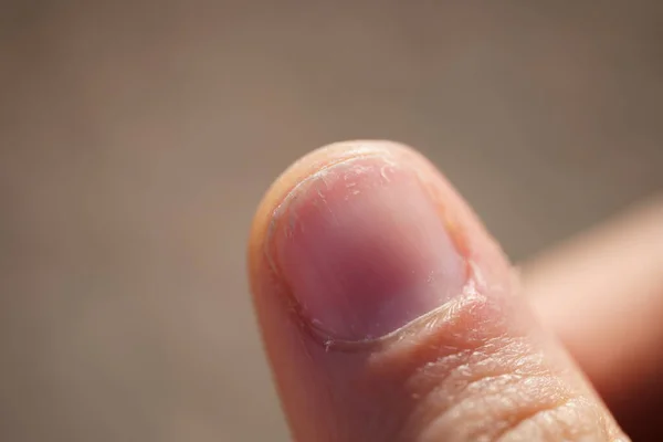 Nahaufnahme Eines Daumens Mit Beschädigtem Nagel — Stockfoto