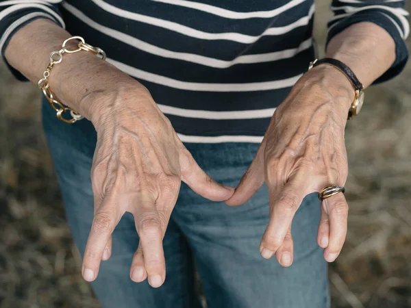 Uma Senhora Idosa Mãos Artrite Envelhecimento — Fotografia de Stock