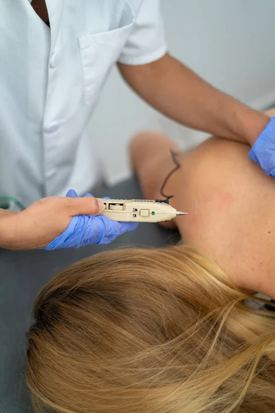 Médico Colocando Uma Caneta Acupuntura Pele Trás Uma Mulher — Fotografia de Stock