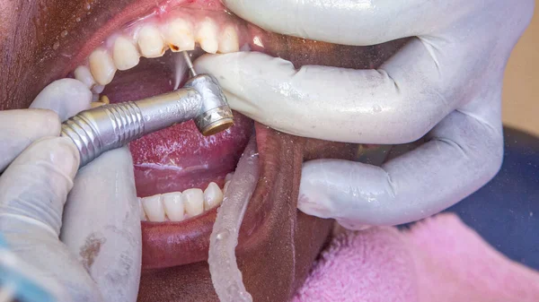 Närbild Bild Tandläkaren Gör Tandvård — Stockfoto