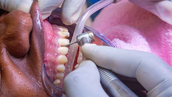 Tiro Perto Dentista Faz Tratamento Dentário — Fotografia de Stock