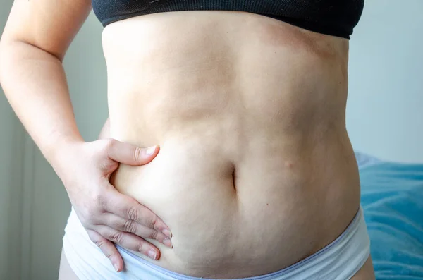 Una Vista Cerca Una Mujer Sosteniendo Estómago Mostrando Celulitis Ropa —  Fotos de Stock