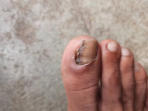 Tiro Close Bigtoe Com Uma Infecção Unha Fúngica — Fotografia de Stock