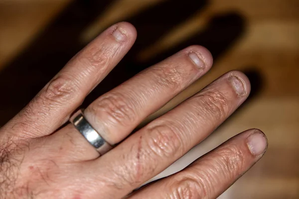 Yüzük Takan Kırık Tırnaklı Bir Erkeğin Parmaklarının Yakın Çekimi — Stok fotoğraf
