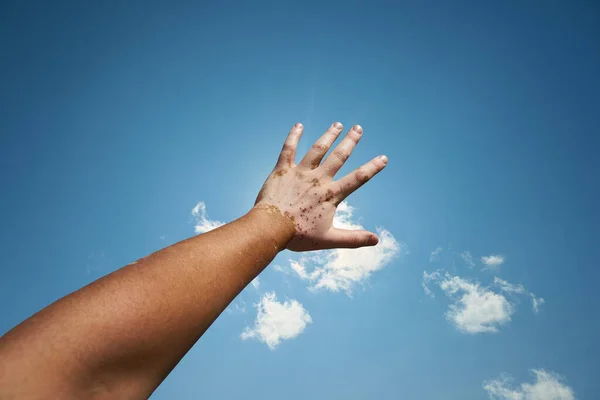 Person Vitiligo Holds Hand Sun — Stock Photo, Image