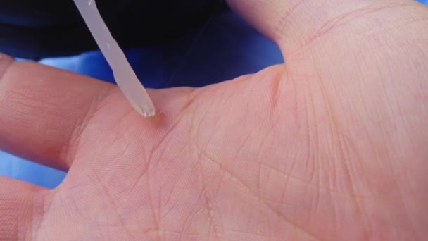 Zbliżenie Ujęcie Lekarza Stosującego Balsam Pryszcze Ręce Pacjenta — Wideo stockowe