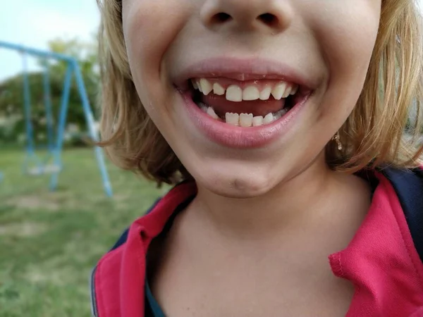 loss of milk teeth. A 6-year-old girl smiles and shows her teeth. Several teeth are missing.