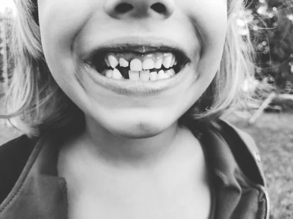 Förlust Mjölktänder Sexårig Flicka Ler Och Visar Tänderna Flera Tänder — Stockfoto
