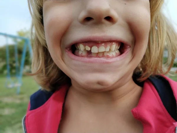 Perda Dentes Leite Uma Menina Anos Sorri Mostra Dentes Faltam — Fotografia de Stock