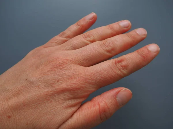 Mano Femminile Con Pelle Atopica Secca Sfondo Bianco Primo Piano — Foto Stock