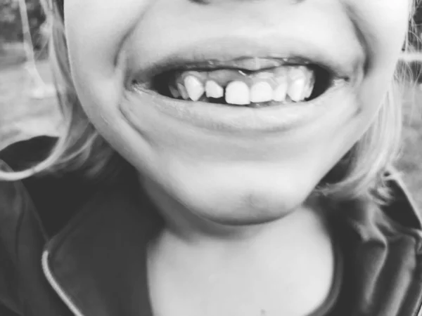 Ztráta Mléčných Zubů Šestiletá Dívka Usměje Ukáže Zuby Chybí Několik — Stock fotografie